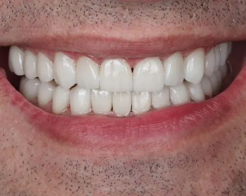Cum ingrijesti fatetele dentare?