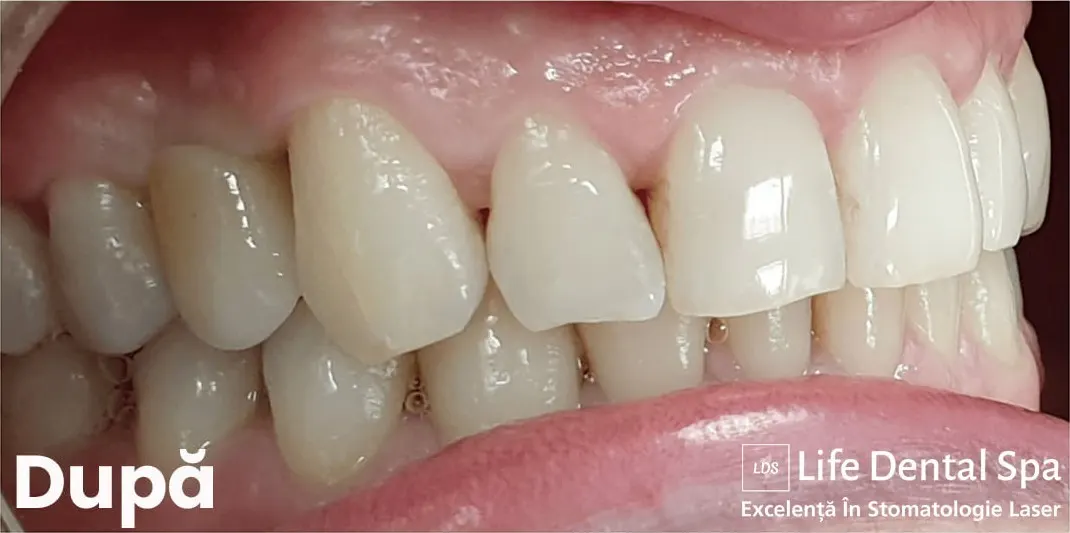 Implant dentar cu coroană ceramică — după tratament
