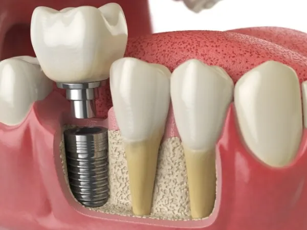 Implant dentar