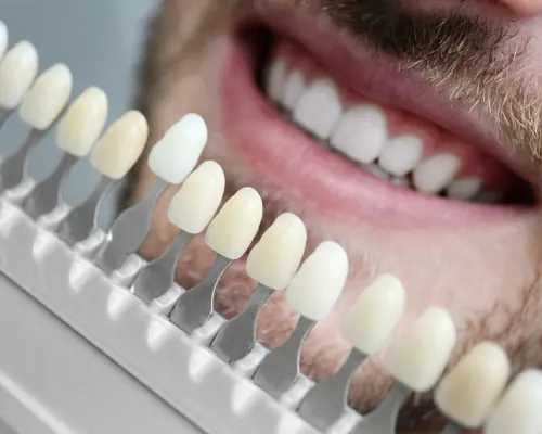 Fatete dentare