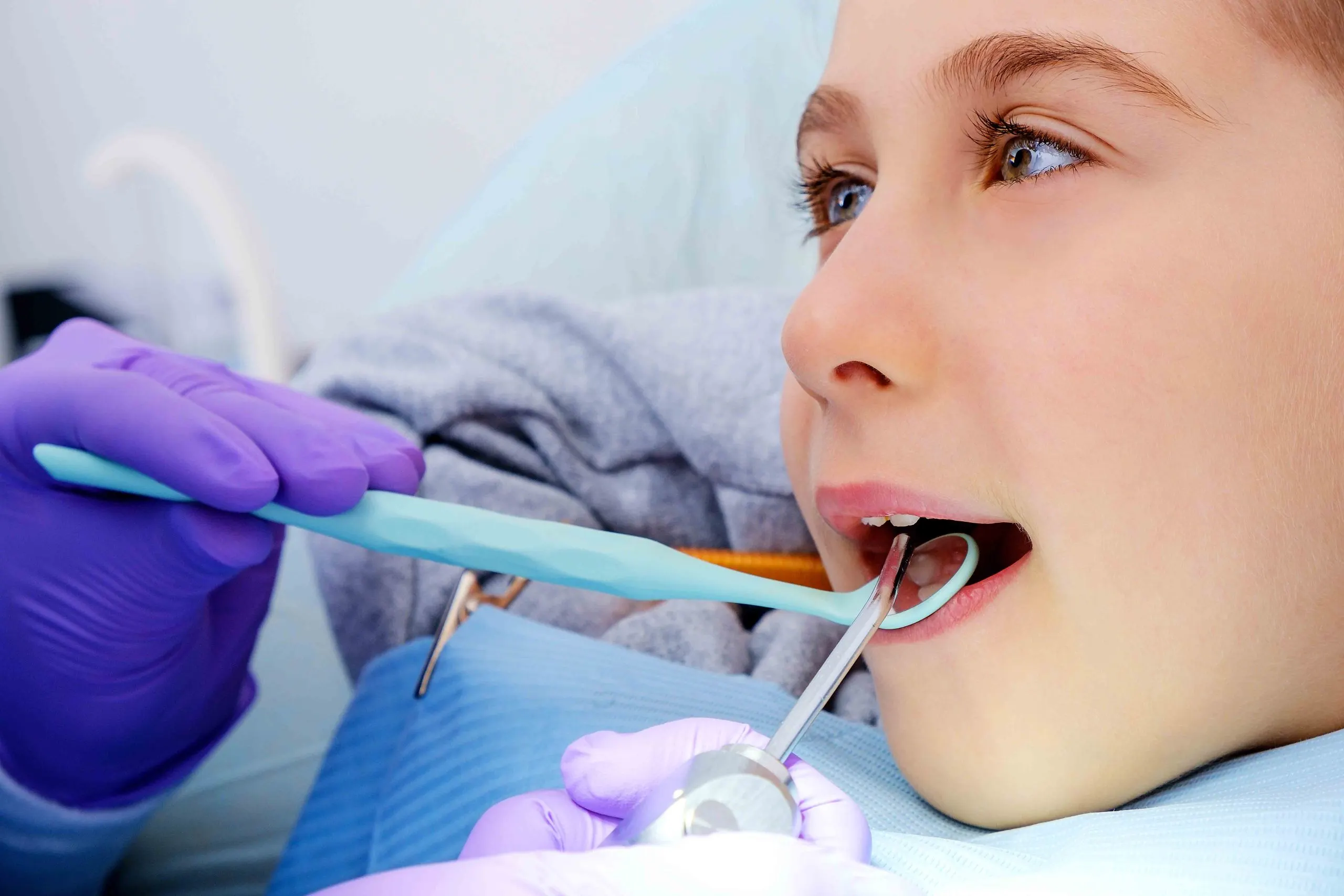 Sigilare dentara cu laser la copii